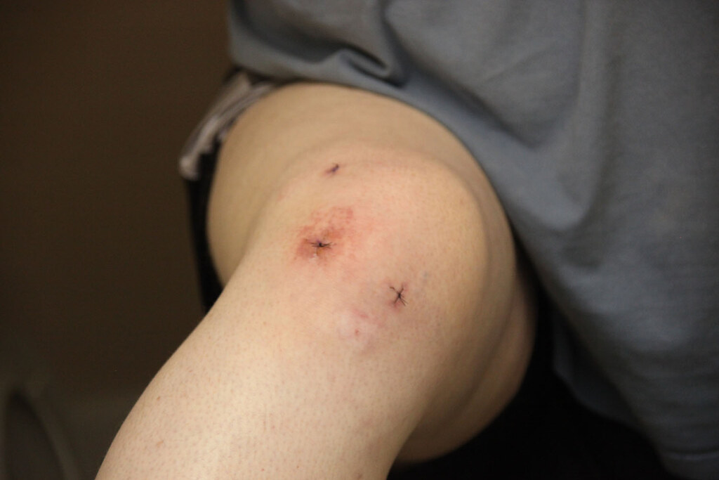 Knee surgery - March 2010 - 0006