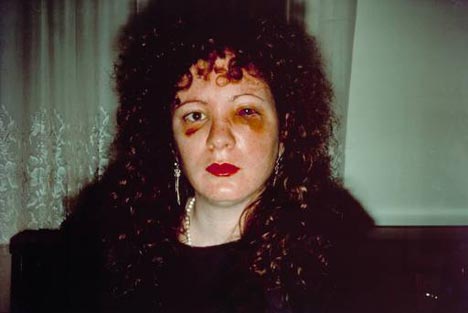 self portrait of Nan Goldin. She has a black eye and a bruised face.