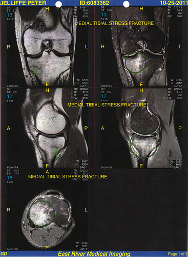 Medial tibial stress fracture