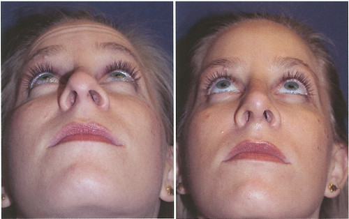 RHINOPLASTY UNDER BEFORE AND AFTER