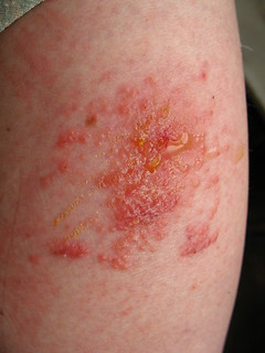 poison ivy rash on my arm