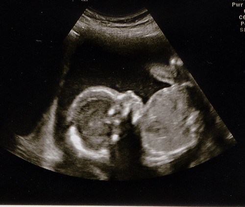 Eve's 20 week ultrasound
