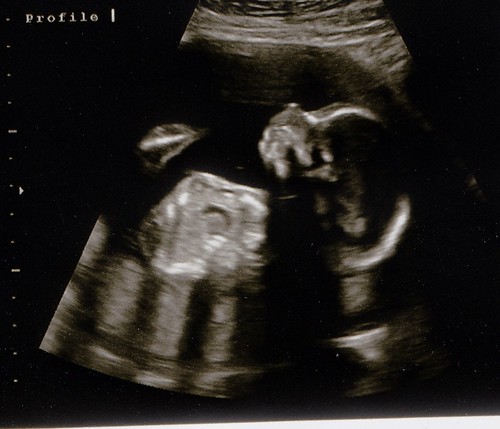 Eve's 20 week ultrasound
