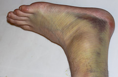 Severely Sprained Ankle