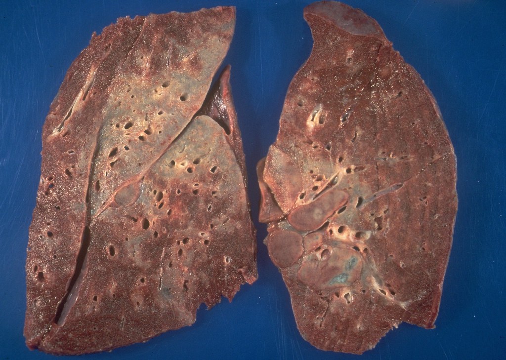 sarcoidosis-lung-granulomas-a-photo-on-flickriver