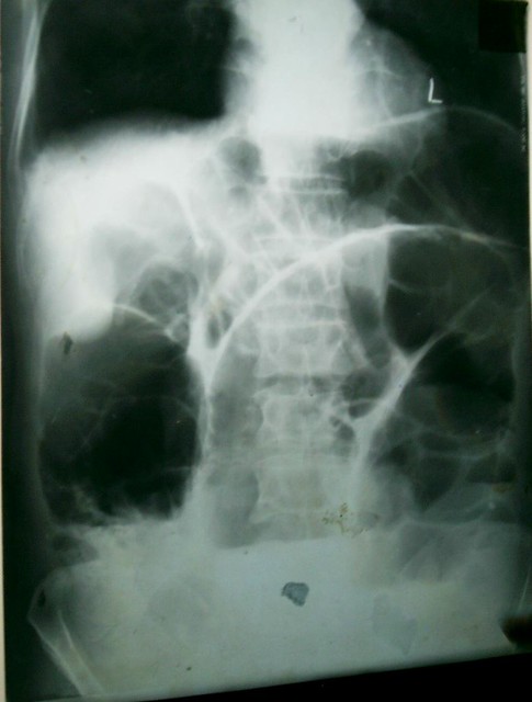 OMEGA SIGN sigmoid colon volvulus | Flickr - Photo Sharing!
 Volvulus X Ray Omega Sign