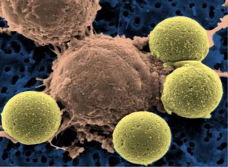 Photo:Leukemia treatment - immune system T-cells (center) binding to beads which cause the cells to divide By:Microbe World