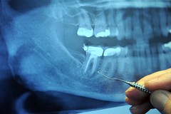 Can Periodontal Disease Be Stopped in its Tracks?